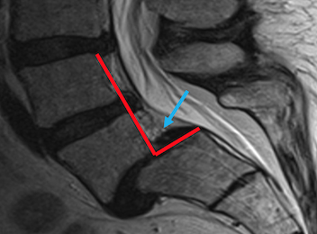 Espondilolistesis