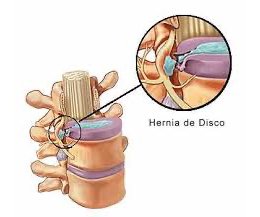 Hernias de Disco